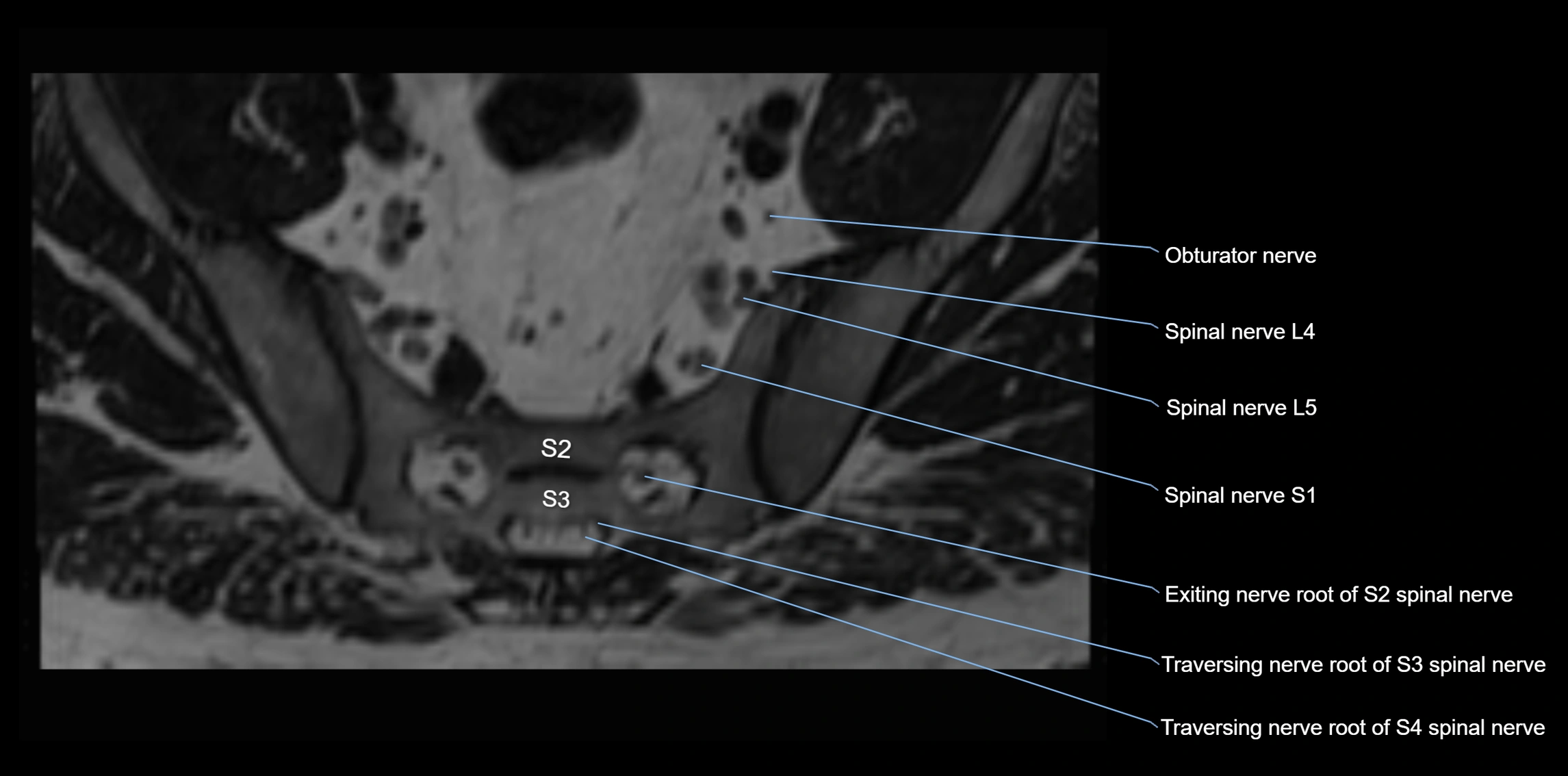 MR lumbosacral plexus axial cross sectional anatomy 3T  radiology  image-img-1008001-00087.webp